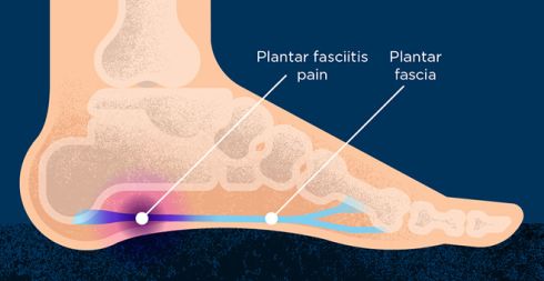 inflammation of the plantar fascia