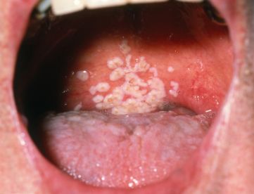 severe fungus infections