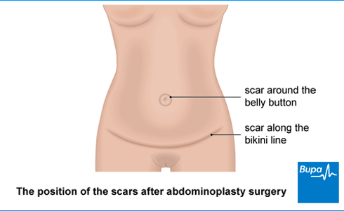 Tummy Tuck Surgery, Abdominoplasty