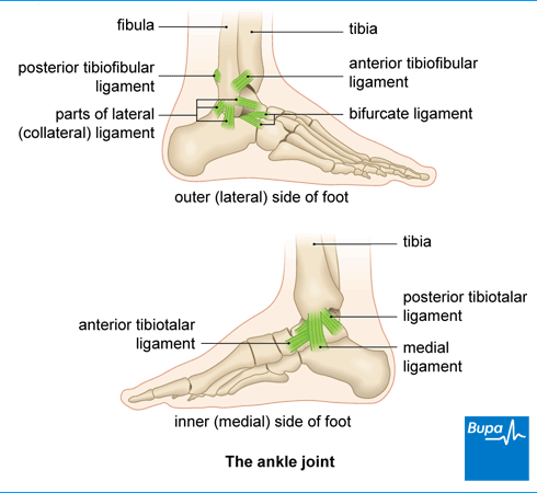 Treating Your Ankle Sprain