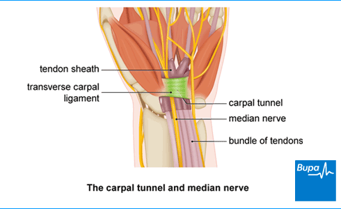 Carpal tunnel syndrome: Non-surgical injections and nerve release