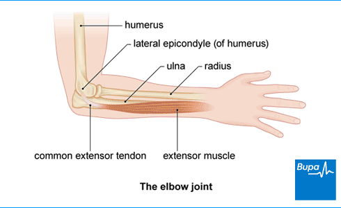 Tennis Elbow: Symptoms, Treatment, Causes
