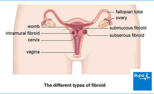 Bulky Uterus: symptoms, causes and treatment - IVI
