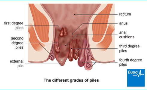 What are Piles? Types, Symptoms, Causes, Treatment, Exercise and Diet