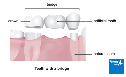 dental bridge parts