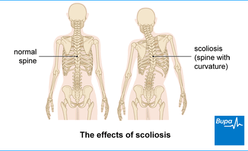 Scoliosis, Health Information