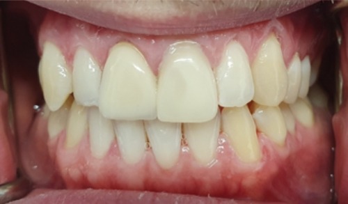 Before and Afters | Bupa Dental Care Loughborough