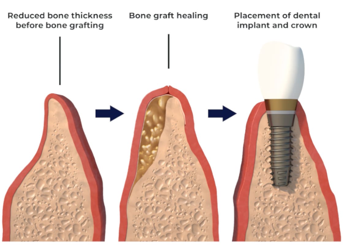 Bone grafts | Options and cost | Bupa Dental Care