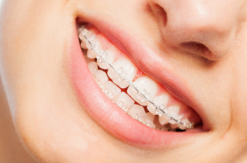 Clear, ceramic braces, Cost & Options