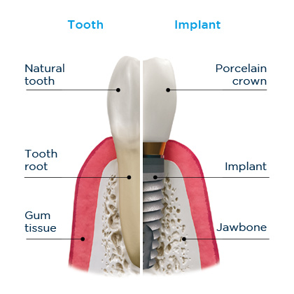 Difference between temporary and permanent dental implants