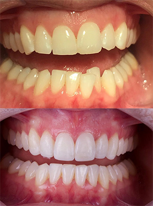 View Before & After Photos  Straighten Teeth With Clear Aligners
