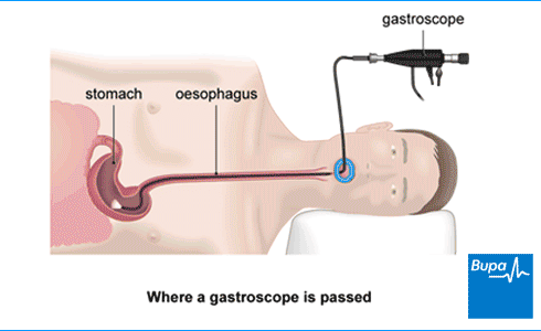 throat scope down test heart Information UK Gastroscopy Bupa  (Endoscopy) Health